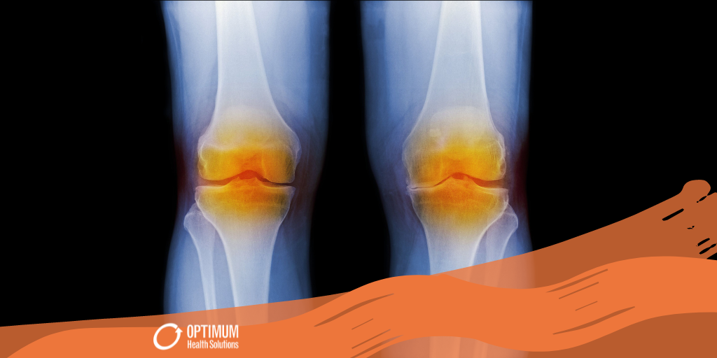 an x-ray of two knees with osteoarthritis. There are transparent red spots highlighting the cartilage issues between the knee joints.