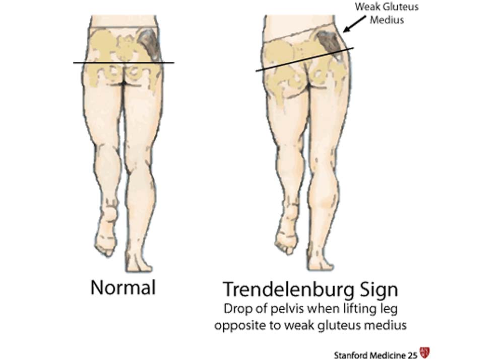 Trendelenburg Gait | Optimum Health Solutions